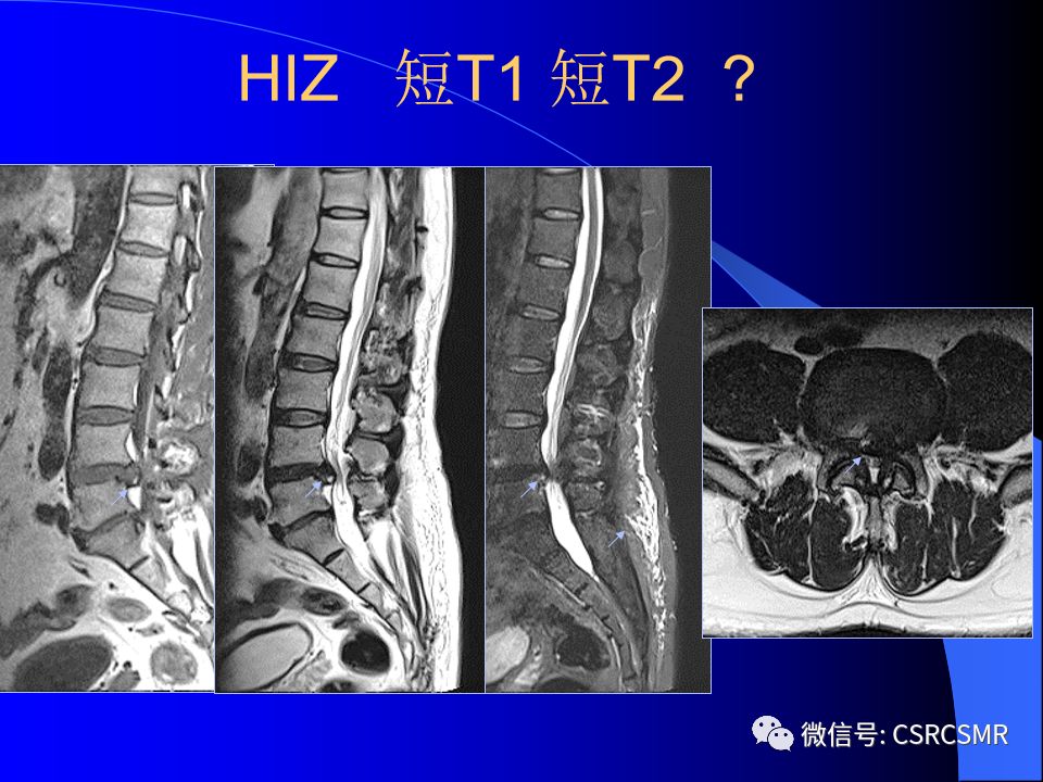 影像PPT - 【PPT】椎间盘发育、退变与病变MRI表现-36