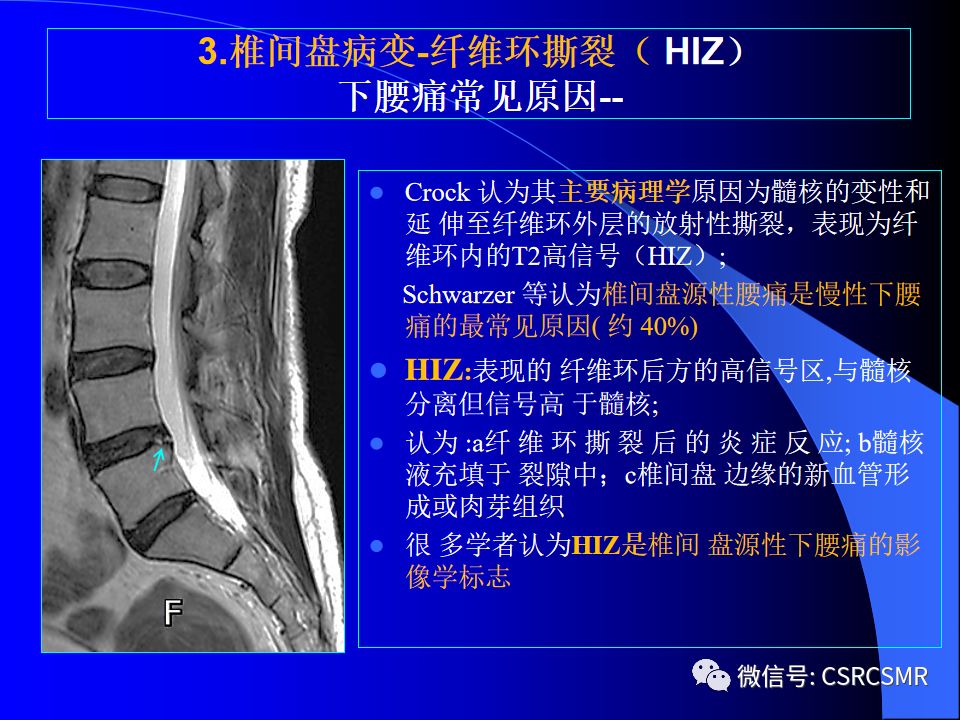 影像PPT - 【PPT】椎间盘发育、退变与病变MRI表现-33