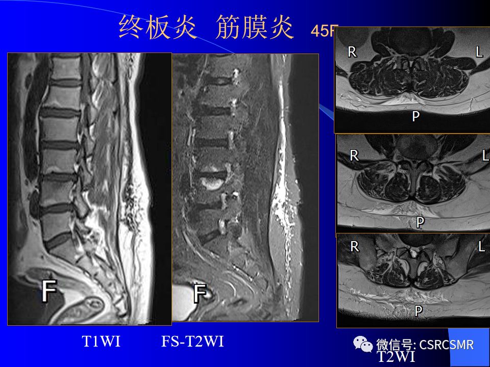 影像PPT - 【PPT】椎间盘发育、退变与病变MRI表现-38