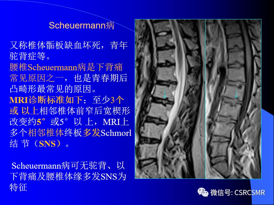 影像PPT - 【PPT】椎间盘发育、退变与病变MRI表现-41