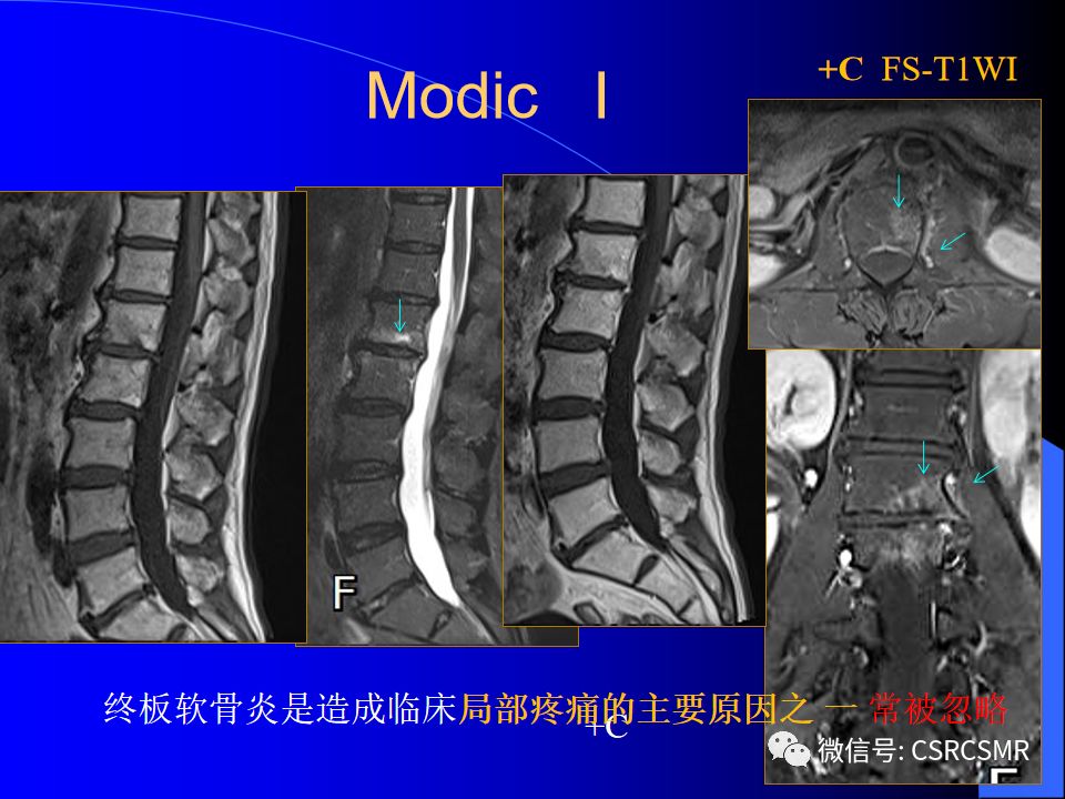影像PPT - 【PPT】椎间盘发育、退变与病变MRI表现-39