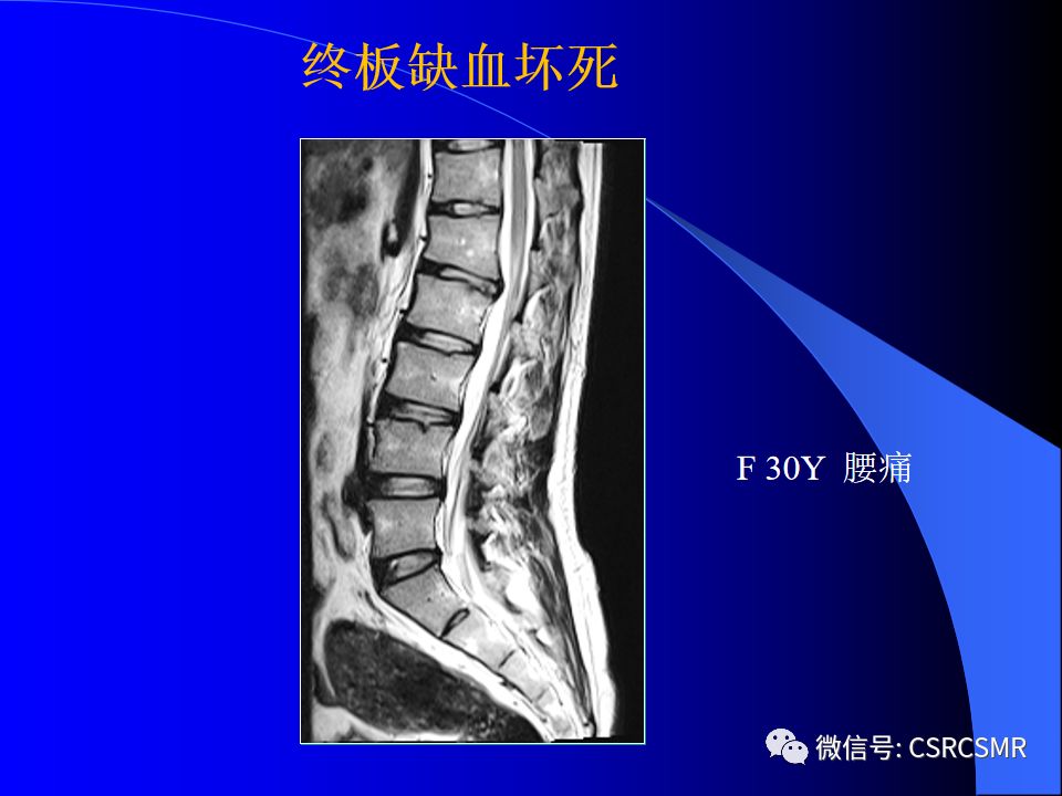 影像PPT - 【PPT】椎间盘发育、退变与病变MRI表现-40