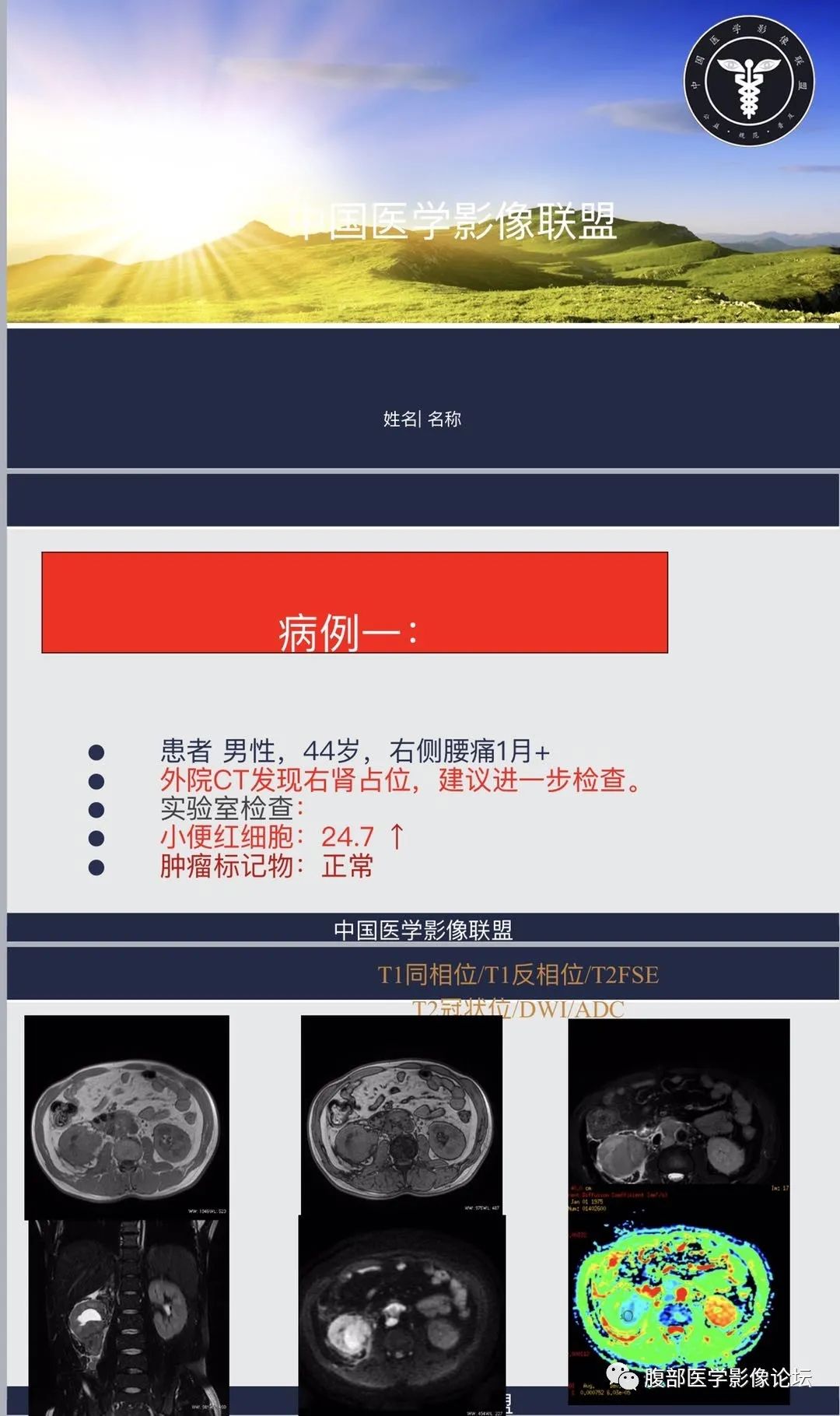 影像PPT - 【PPT】肾脏淋巴瘤1例CT及MR-1