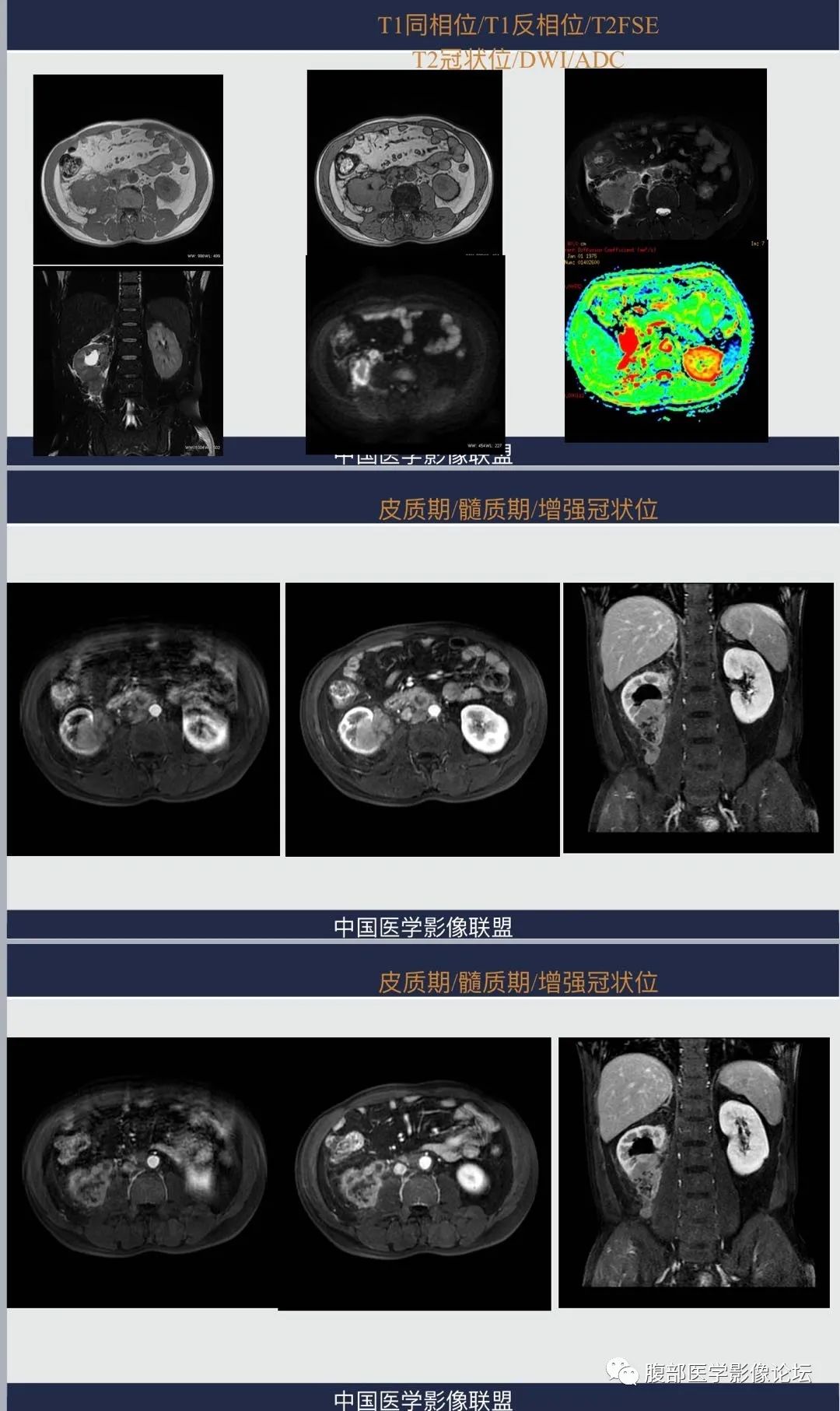 影像PPT - 【PPT】肾脏淋巴瘤1例CT及MR-2