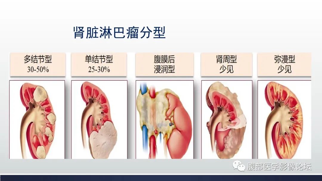 影像PPT - 【PPT】肾脏淋巴瘤1例CT及MR-5