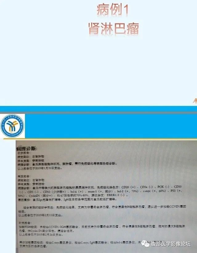 影像PPT - 【PPT】肾脏淋巴瘤1例CT及MR-4