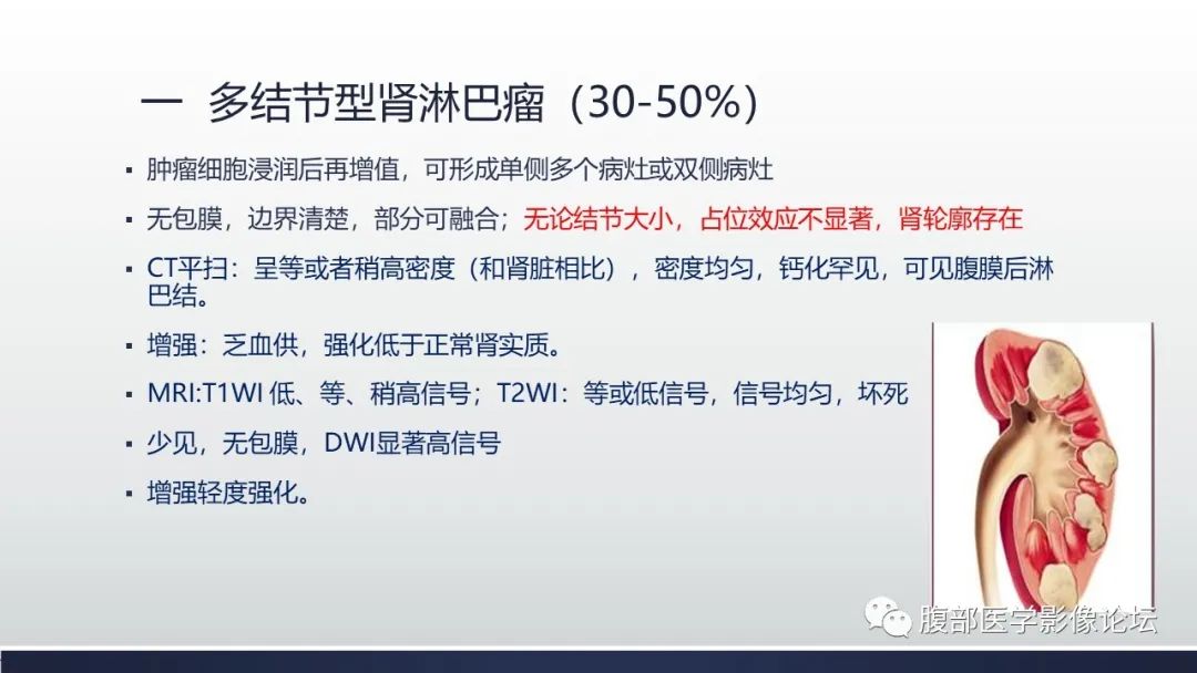 影像PPT - 【PPT】肾脏淋巴瘤1例CT及MR-6
