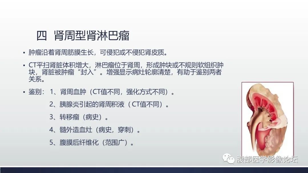 影像PPT - 【PPT】肾脏淋巴瘤1例CT及MR-14
