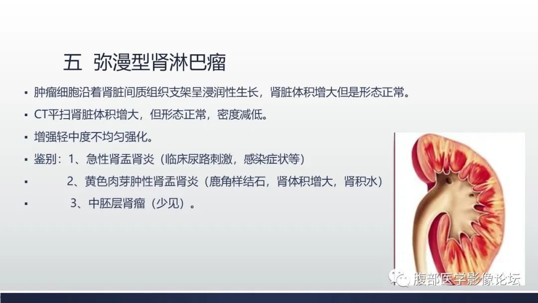 影像PPT - 【PPT】肾脏淋巴瘤1例CT及MR-17