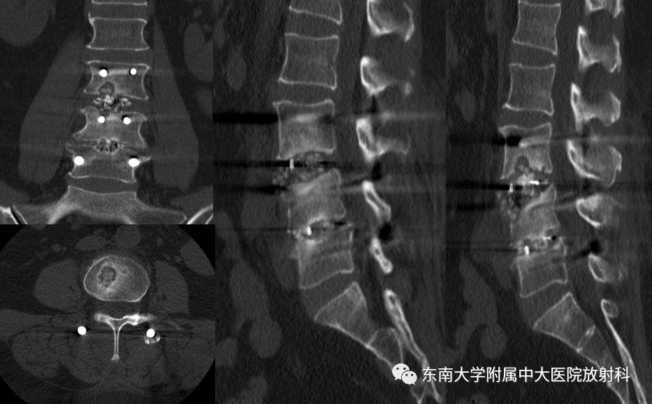 影像PPT - 【PPT】腰椎椎间融合术后影像学评估-1 影像PPT - 【PPT】腰椎椎间融合术后影像学评估-1
