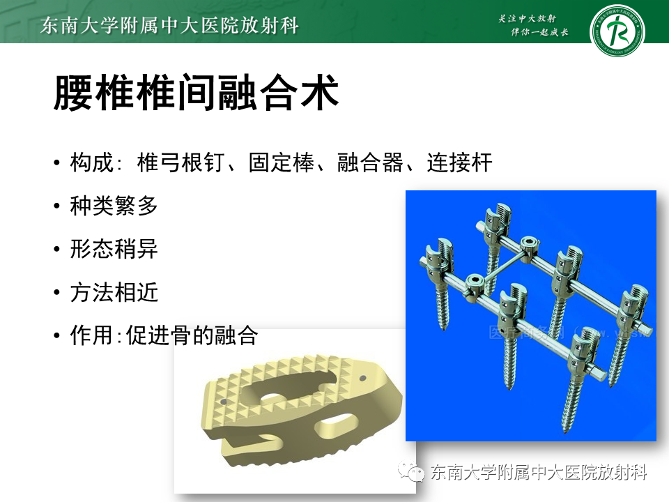 影像PPT - 【PPT】腰椎椎间融合术后影像学评估-5 影像PPT - 【PPT】腰椎椎间融合术后影像学评估-5