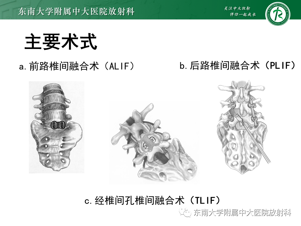 影像PPT - 【PPT】腰椎椎间融合术后影像学评估-6 影像PPT - 【PPT】腰椎椎间融合术后影像学评估-6