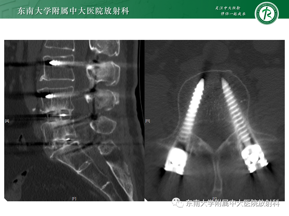 影像PPT - 【PPT】腰椎椎间融合术后影像学评估-10 影像PPT - 【PPT】腰椎椎间融合术后影像学评估-10