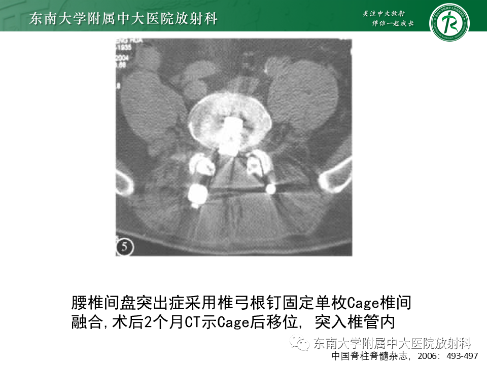 影像PPT - 【PPT】腰椎椎间融合术后影像学评估-18 影像PPT - 【PPT】腰椎椎间融合术后影像学评估-18