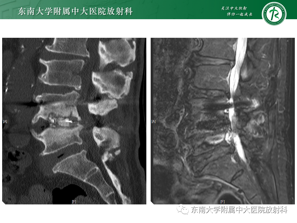 影像PPT - 【PPT】腰椎椎间融合术后影像学评估-17 影像PPT - 【PPT】腰椎椎间融合术后影像学评估-17