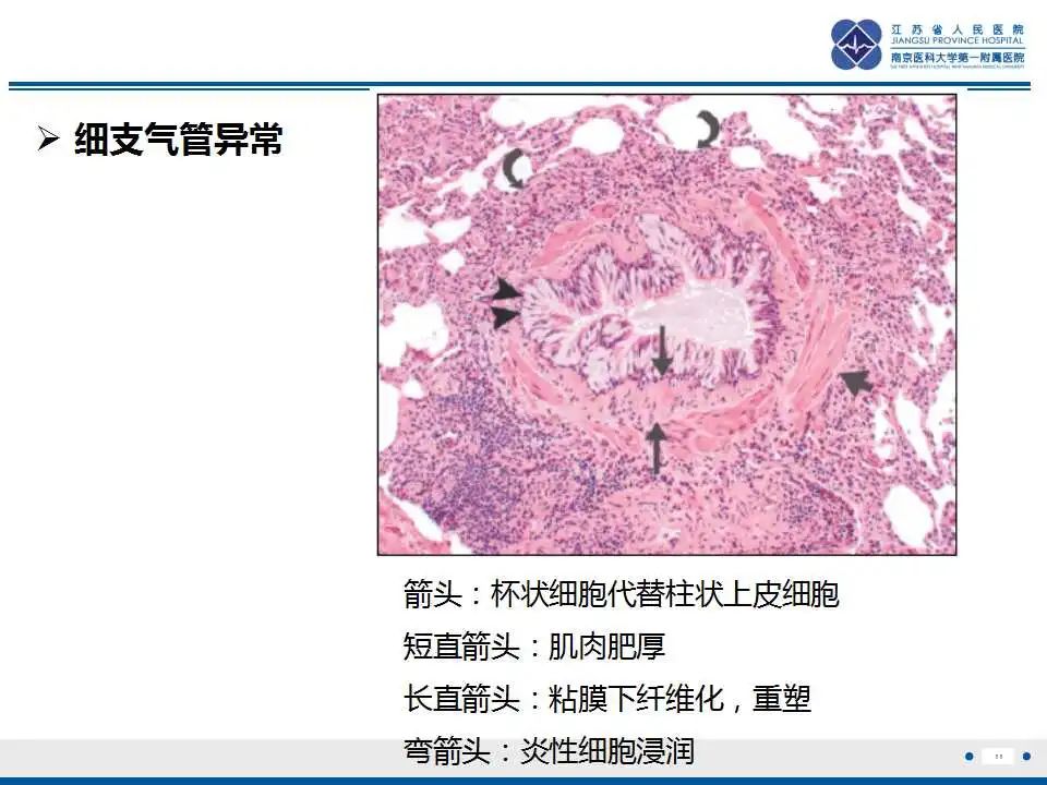 影像PPT - 【PPT】嗜酸性肉芽肿性多血管炎-12
