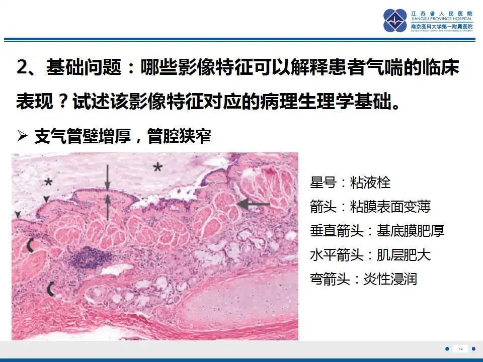 影像PPT - 【PPT】嗜酸性肉芽肿性多血管炎-11