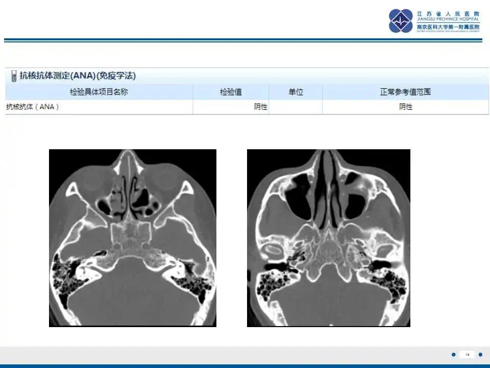 影像PPT - 【PPT】嗜酸性肉芽肿性多血管炎-17