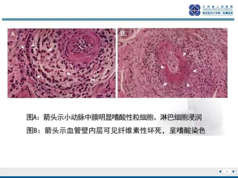 影像PPT - 【PPT】嗜酸性肉芽肿性多血管炎-24