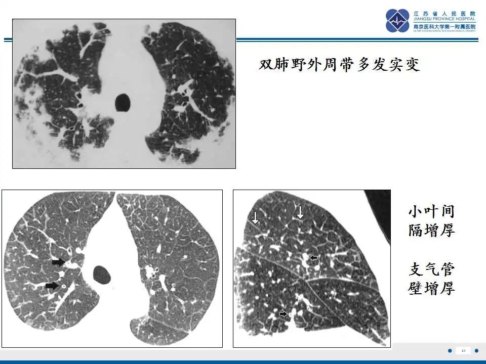 影像PPT - 【PPT】嗜酸性肉芽肿性多血管炎-32