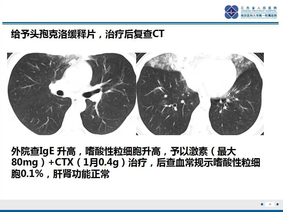 影像PPT - 【PPT】嗜酸性肉芽肿性多血管炎-36