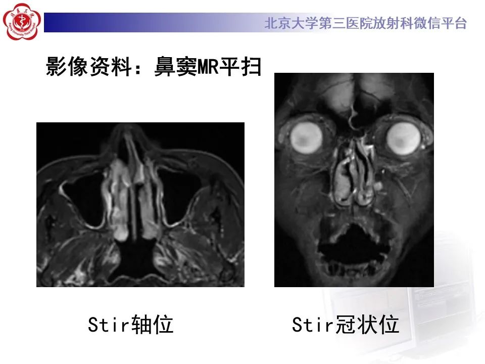 影像PPT - 【PPT】鼻腔鼻窦恶性黑色素瘤-4