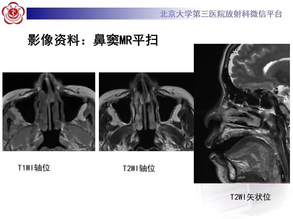 影像PPT - 【PPT】鼻腔鼻窦恶性黑色素瘤-3