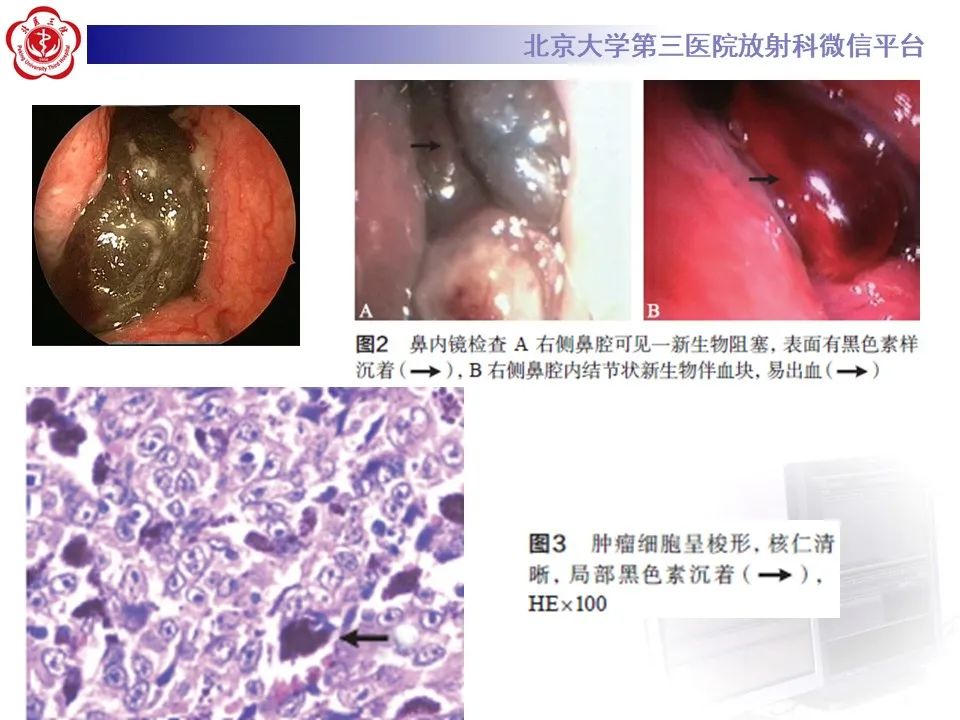 影像PPT - 【PPT】鼻腔鼻窦恶性黑色素瘤-12