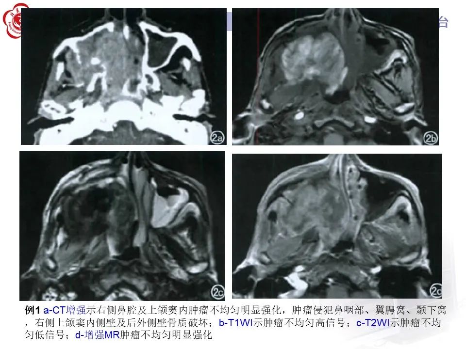 影像PPT - 【PPT】鼻腔鼻窦恶性黑色素瘤-16