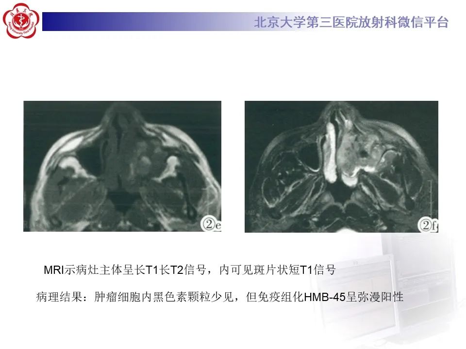 影像PPT - 【PPT】鼻腔鼻窦恶性黑色素瘤-21