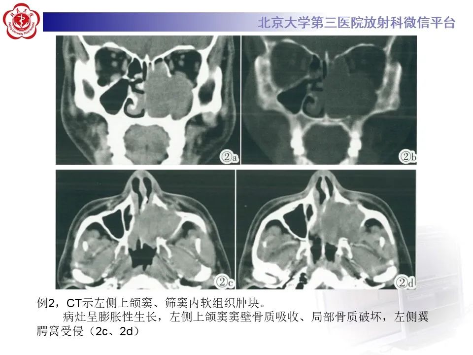 影像PPT - 【PPT】鼻腔鼻窦恶性黑色素瘤-20