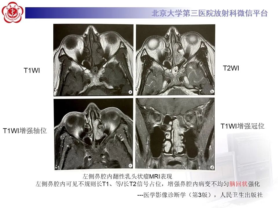 影像PPT - 【PPT】鼻腔鼻窦恶性黑色素瘤-27