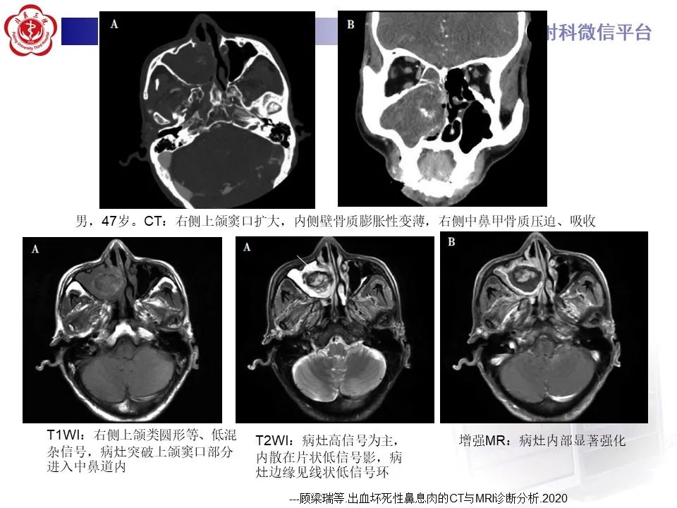 影像PPT - 【PPT】鼻腔鼻窦恶性黑色素瘤-25