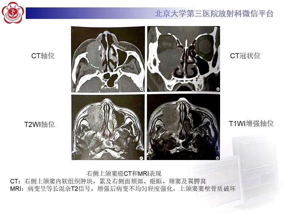 影像PPT - 【PPT】鼻腔鼻窦恶性黑色素瘤-29