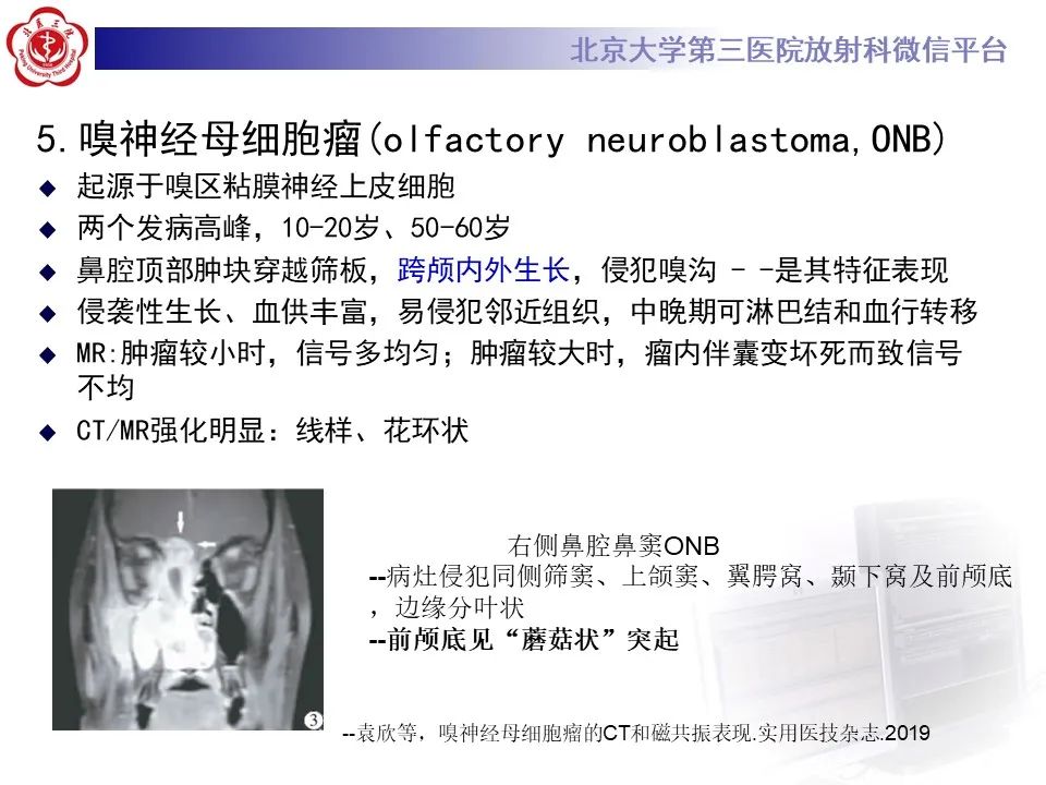 影像PPT - 【PPT】鼻腔鼻窦恶性黑色素瘤-32