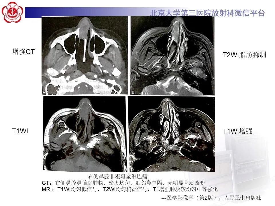 影像PPT - 【PPT】鼻腔鼻窦恶性黑色素瘤-31