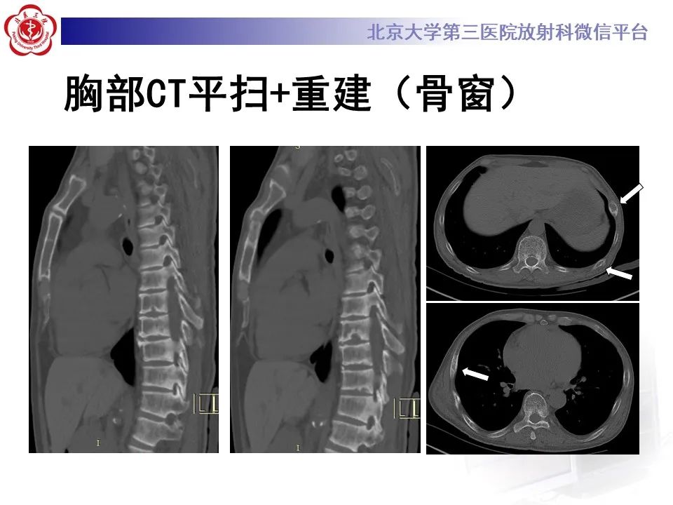 影像PPT - 【PPT】脊柱棕色瘤-4