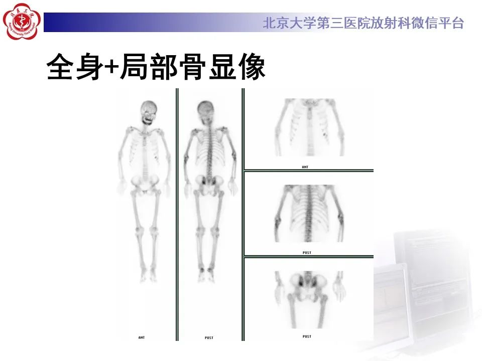 影像PPT - 【PPT】脊柱棕色瘤-6