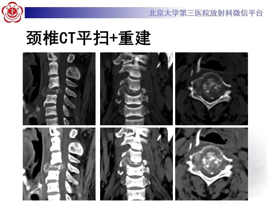影像PPT - 【PPT】脊柱棕色瘤-3