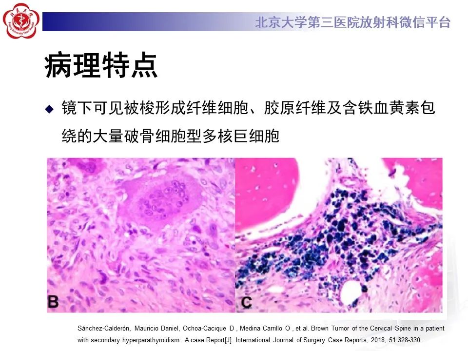 影像PPT - 【PPT】脊柱棕色瘤-13