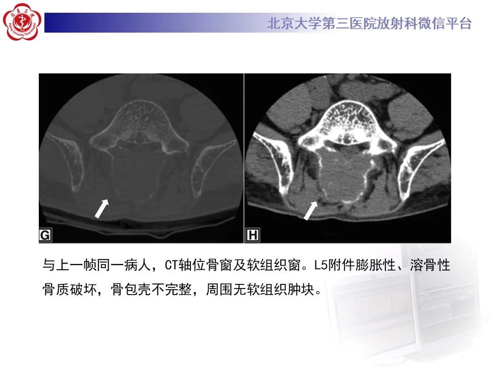 影像PPT - 【PPT】脊柱棕色瘤-17