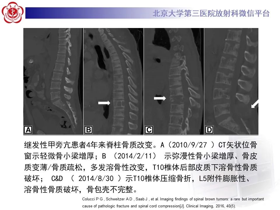 影像PPT - 【PPT】脊柱棕色瘤-16