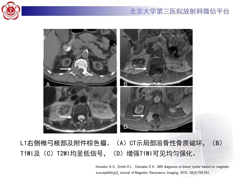 影像PPT - 【PPT】脊柱棕色瘤-19