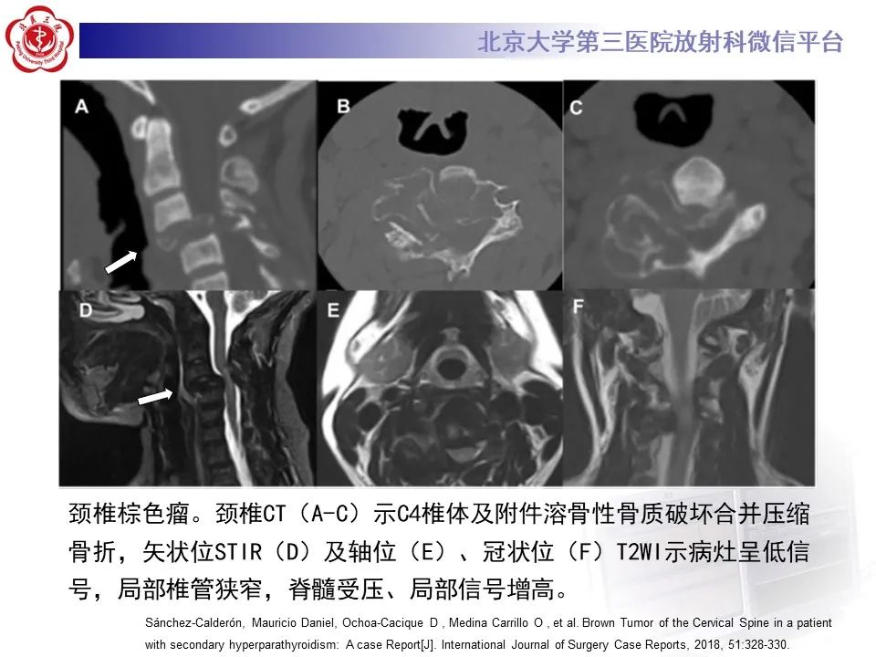 影像PPT - 【PPT】脊柱棕色瘤-20