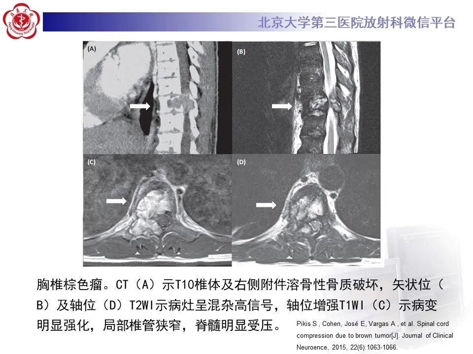 影像PPT - 【PPT】脊柱棕色瘤-22
