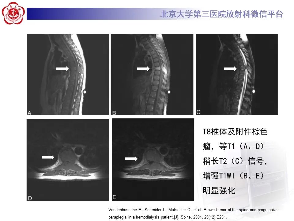 影像PPT - 【PPT】脊柱棕色瘤-21