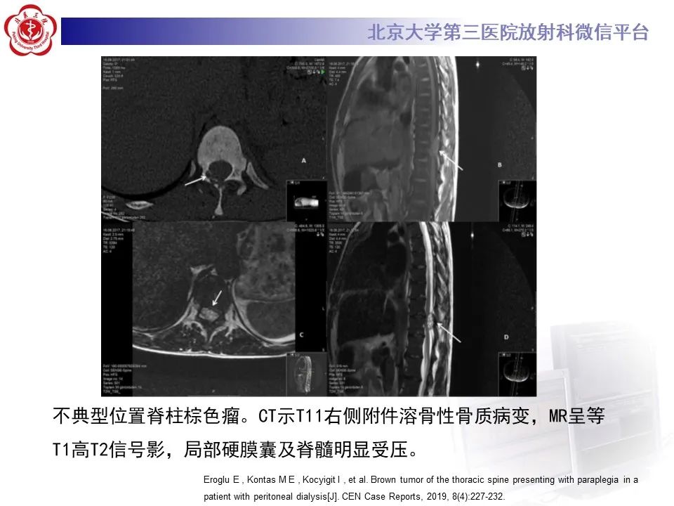 影像PPT - 【PPT】脊柱棕色瘤-23