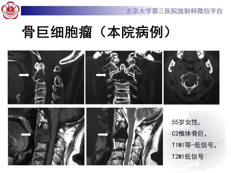 影像PPT - 【PPT】脊柱棕色瘤-27