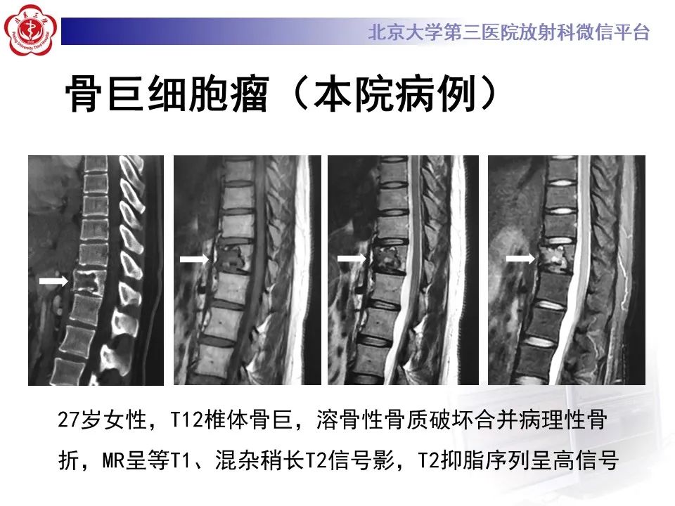 影像PPT - 【PPT】脊柱棕色瘤-26
