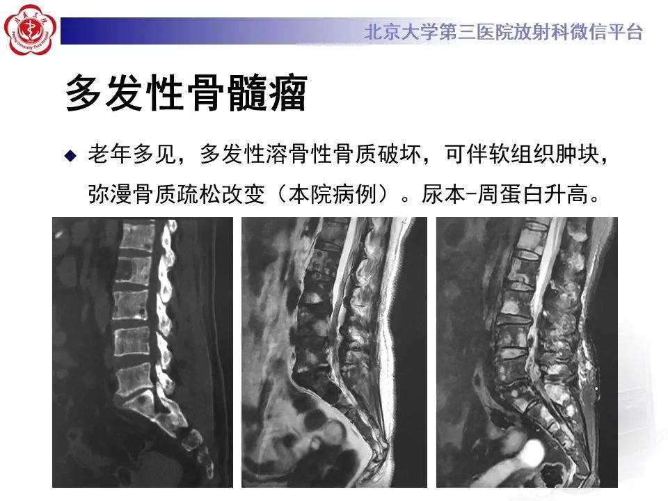 影像PPT - 【PPT】脊柱棕色瘤-28